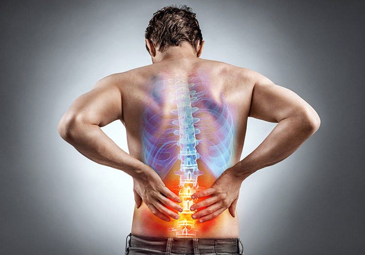 A graphic depiction of nerve pain in the back
