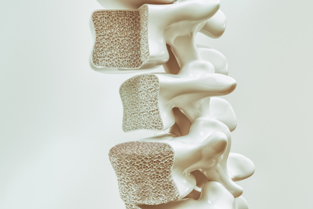 The Connection Between Bone Density & Spine Surgery: What to Know