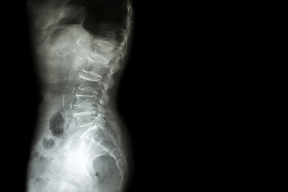 Spondylosis & Spondylolisthesis film x-ray