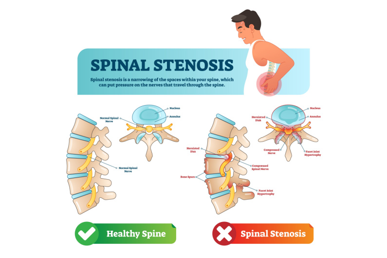 Animated diagram showing a healthy spine versus a spine with spinal stenosis