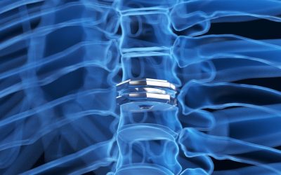 How to Know Spinal Disc Replacement Surgery is Right for You