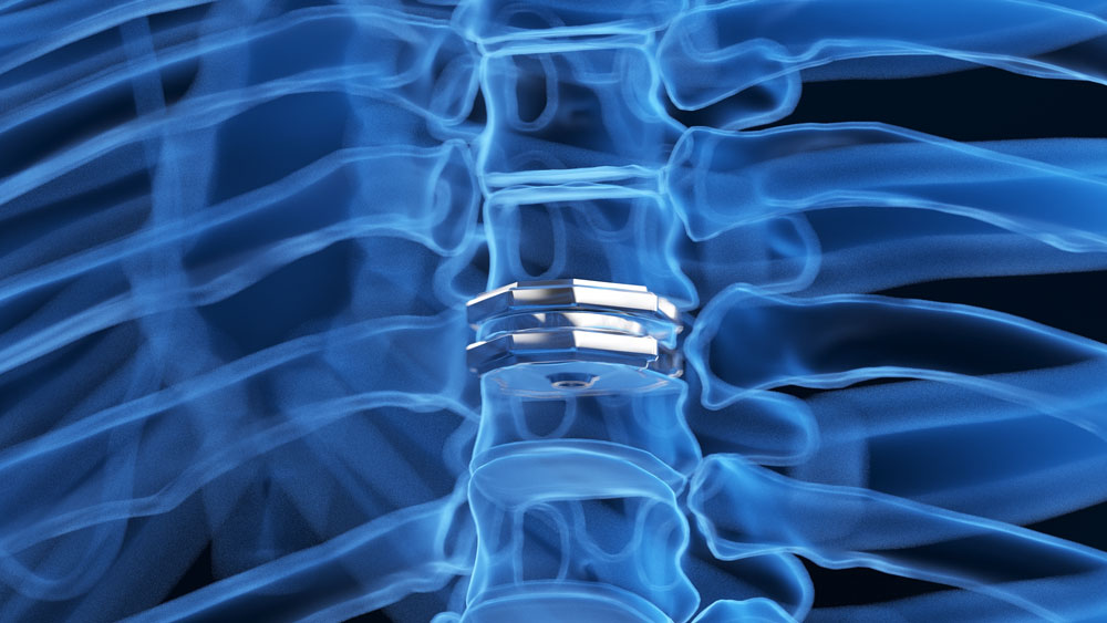 Cervical disc replacement