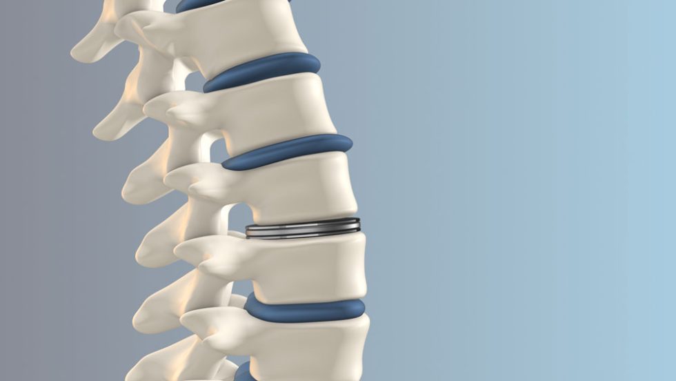 When to Consider Disc Replacement Surgery | Desert Spine