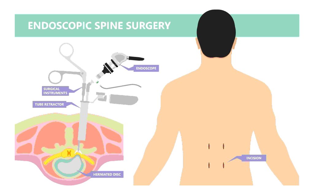 Animated image of endoscopic spine surgery vs open back surgery 
