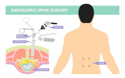 Is Minimally Invasive Spine Surgery Right for You?
