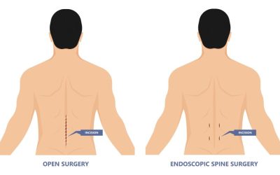 4 Types of Spinal Decompression Surgery