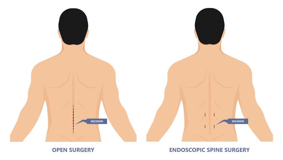 4 Types of Spinal Decompression Surgery