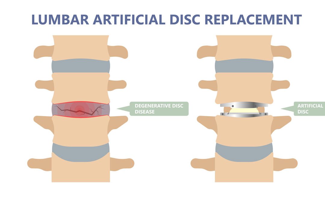 Lumbar artificial disc replacement vector