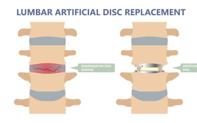 Spinal Fusion vs Disc Replacement: When to Consider Each