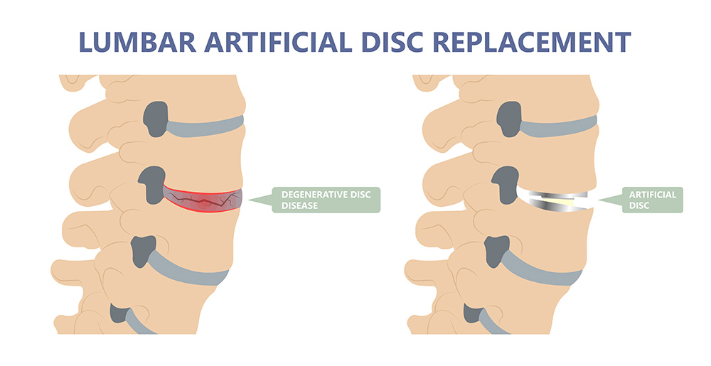 Lumbar artificial disc replacement