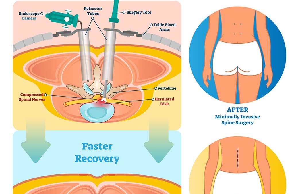 Minimally invasive spine surgery vs traditional open spine surgery