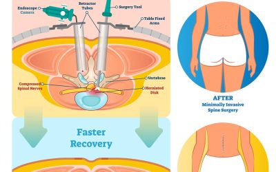 Minimally Invasive Spine Surgery vs Traditional Spine Surgery: A Comparative Guide