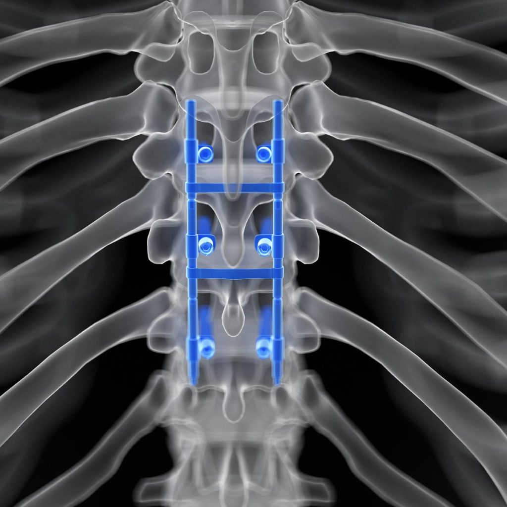 Spinal fusion animated rendering