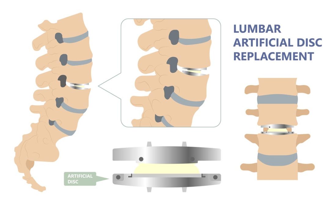 Lumbar artificial disc replacement