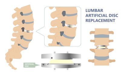 How Artificial Discs Mimic Natural Disc Function