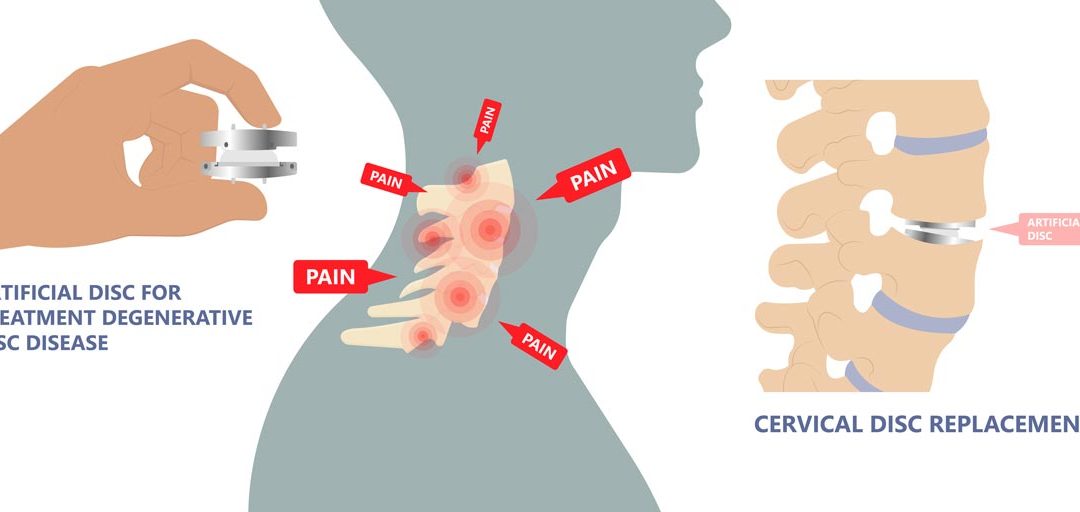 Cervical artificial disc replacement