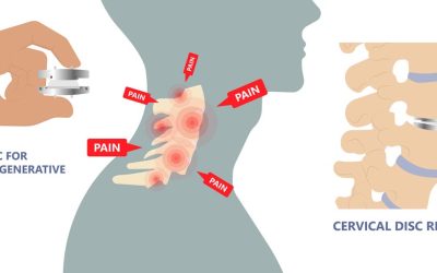 Key Points to Understand About Cervical Artificial Disc Replacement