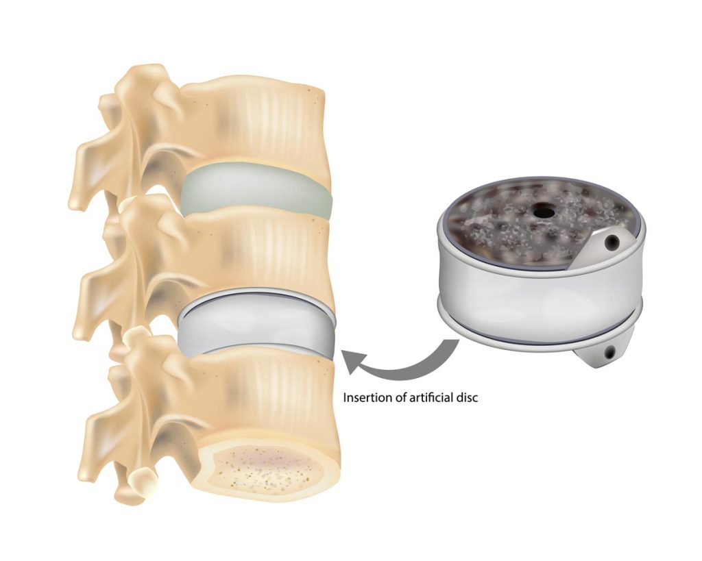 Insertion of artificial disc