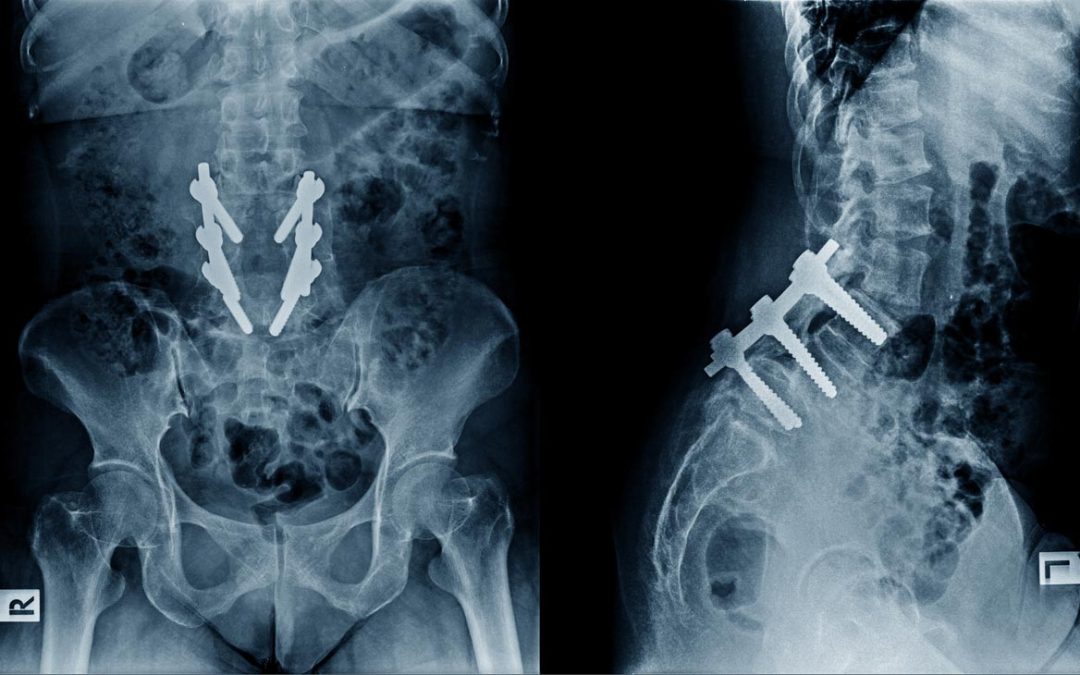 Spinal Fusion