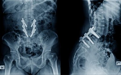 Understanding the Main Types of Spine Fusion Surgery